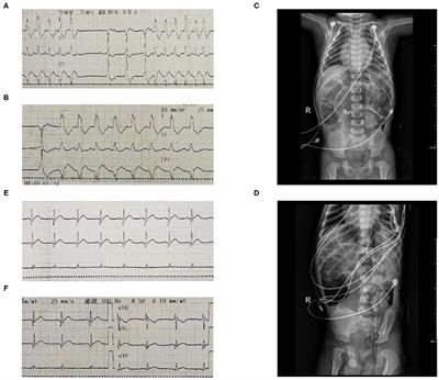 Case Report: Hypothyroidism Misdiagnosed as Fulminant Myocarditis in a Child